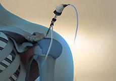 Arthroscopic Surgery