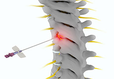 Facet Injections