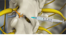 Medial Branch Block Injections