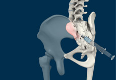 Peripheral Joint Injections