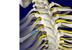 Selective Nerve Block